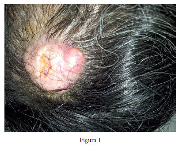Carcinoma espinocelular en cuero cabelludo